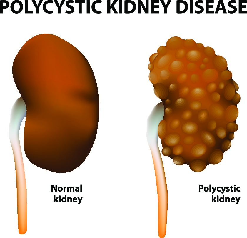 Cystic Kidney Disease