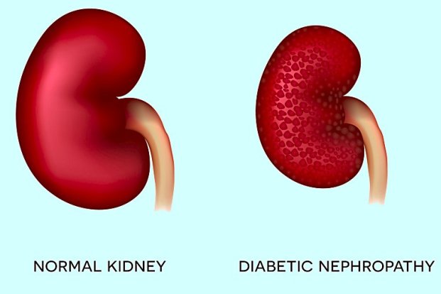 Diabetic Kidney Diseases