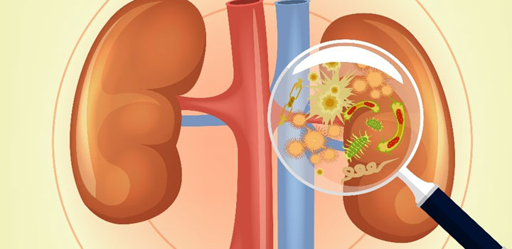 Recurrent Kidney Infections